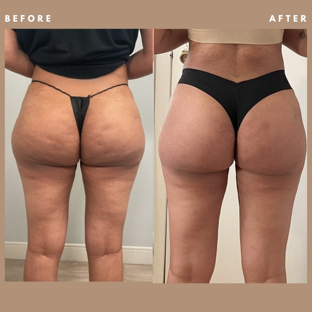EMS Toning Short | For Cellulite on Bum