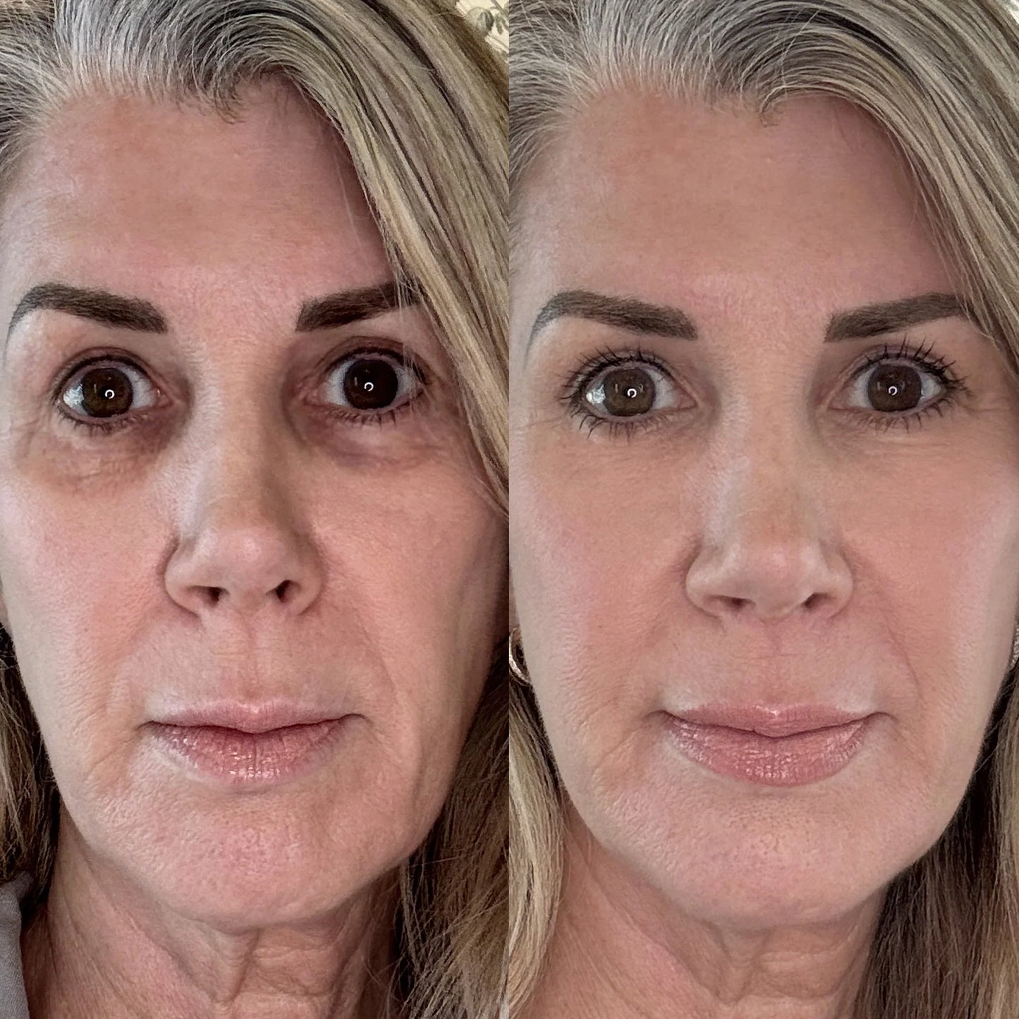 Red Light + EMS Under-Eye Therapy